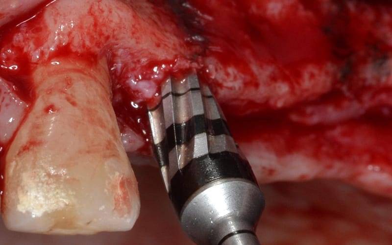 Protocolli Chirurgici Di Osseodensificazione: Nuove Prospettive Per Ottimizzare Il Sito Implantare