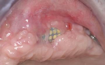 Errori, Complicanze e Insuccessi In Chirurgia Orale e Implantare: Come Evitarli, Come Gestirli