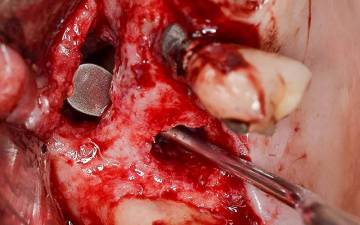 Errori, Complicanze e Insuccessi In Chirurgia Orale e Implantare: Come Evitarli, Come Gestirli