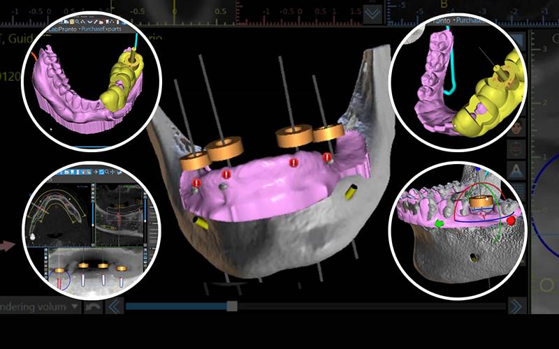 Corso su BlueSkyPlan, software 3D gratuito per Chirurgia Implantare: come progettare dime chirurgiche per edentulie parziali e totali (+ 2 video bonus)