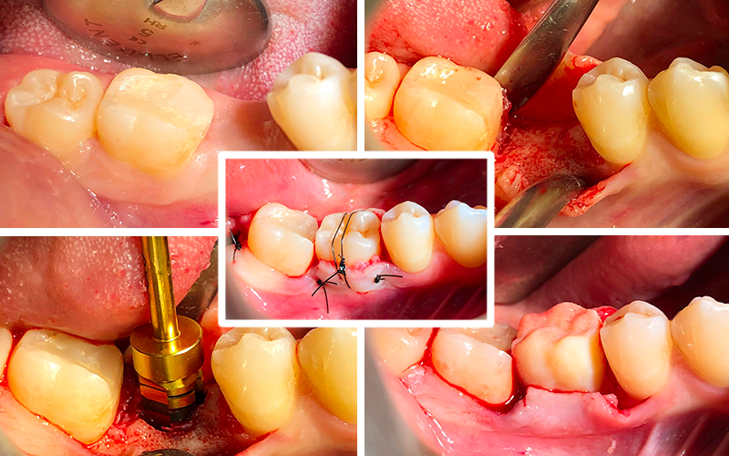 Le Trasposizioni Dentarie: Autotrapianti e Reimpianti